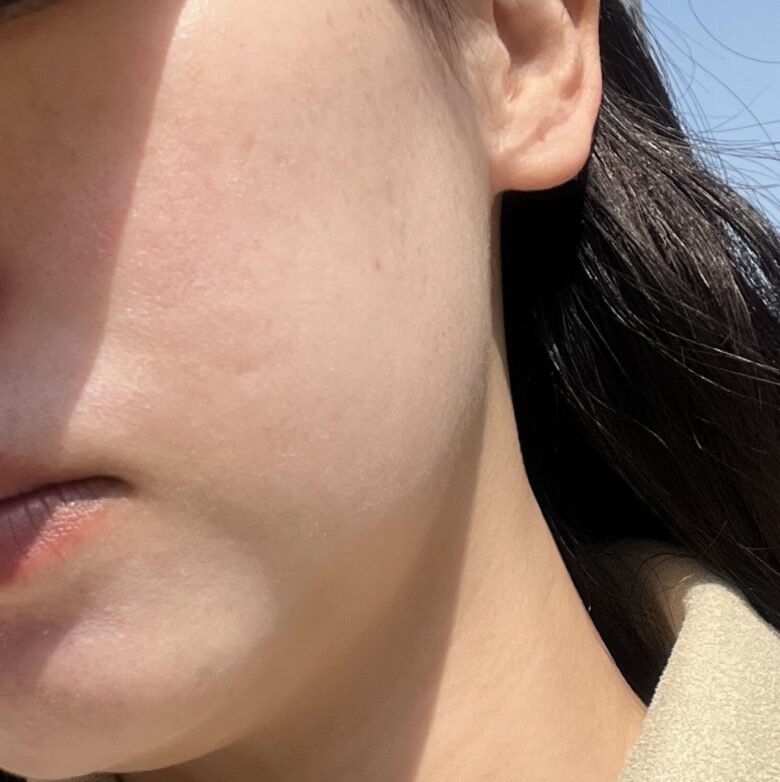 デイビュークリニック　施術翌日